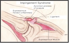 Impingment Syndrome