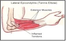 Tennis elbow/lateral epicondylitis