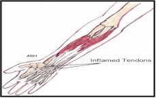 Wrist tenosynovitis