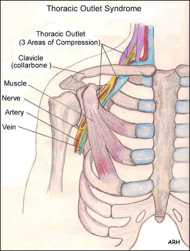 thoracic-outlet-syndrome.jpg